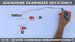 Adenosine Deaminase Deficiency  SCID [upl. by Enelyt]