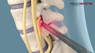 Fullendoscopic spinal treatment of herniated discs and spinal canal stenosis [upl. by Llevra]