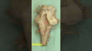 Facial colliculus Rhomboid fossa neuroanatomy brain brainstemrhomboidfossa [upl. by Aihsenak]