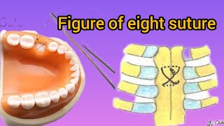 figure of 8 suture  figure of eight suture suturing technique [upl. by Ruggiero]