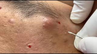 BuBuPlus  Treatment Face By Removal Blackheads By Your Own Self [upl. by Lavery265]