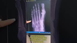 Jones Fracture  Diagnosis and Treatment [upl. by Shayne359]