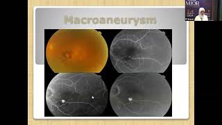 Optical coherent tomography OCT basics and in different vascular and hereditary retinal diseases [upl. by Jemma]