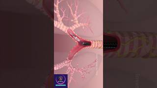 Lung Denervation Procedure  COPD Disease Treatment lungdisease [upl. by Treacy]