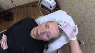 Botox Injections Brow Lift  Huntington Long Island NY Plastic Surgeon [upl. by Cherilyn]