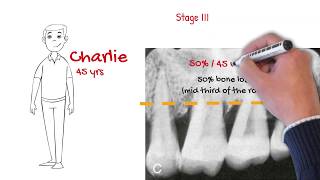 The new periodontal classification MUST WATCH FOR ALL DENTISTS [upl. by Sam]