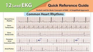 Understanding ECG Findings A Comprehensive Guide [upl. by Mayes]