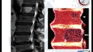 Spinal Tumours 4 Vertebral Hemangioma الوحمة الدموية بالعمود الفقري [upl. by Elkin]