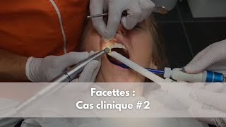 Facettes  Cas clinique 2 [upl. by Ellehciram]