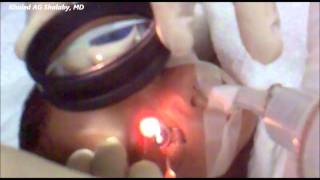 Laser Treatment of Retinopathy of prematurity ROP [upl. by Cimbura]