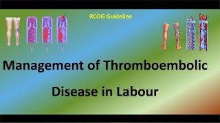 Management of Thromboembolic Disease in Labour [upl. by Enilec]