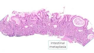 Autoimmune gastritis and differential diagnosis [upl. by Maclay571]