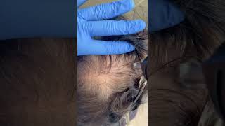 Hair Restoration with Alma TED [upl. by Carleen]