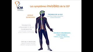 Les symptômes de la sclérose en plaques [upl. by Cooe]