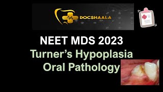 Turners Hypoplasia  Oral Pathology  NEET MDS Recall 2023 [upl. by Ambros]