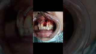 large cyst in maxilla [upl. by Laden]