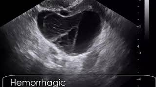 case 609 Hemorrhagic corpus luteum cyst CLC [upl. by Lubeck914]