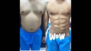 Belly Liposuction Results Vaser Lipo before After [upl. by Dilahk]