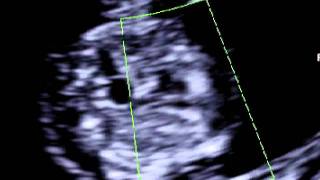 Fetal heart scan at 11 weeks of pregnancy [upl. by Fortna221]