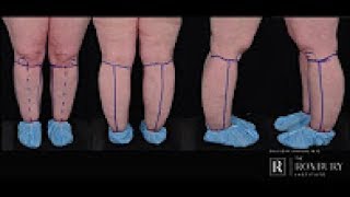 What is Lipedema [upl. by Breskin206]