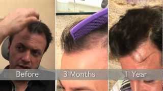 Hair Transplants and Micro Scalp Pigmentation  Vinci Hair Clinic [upl. by Mckay163]