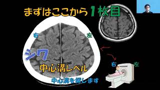 SCU看護（急性期の脳卒中ケア）amp脳画像の見方（Ver2）サンプル動画 [upl. by Robena]