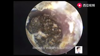 Dry cerumen and cholesteatoma 12 minutes [upl. by Quitt679]