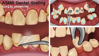 ASMR Satisfying braces animation  Tartar Removal  Dental Scaling  orthodontic [upl. by Feledy]