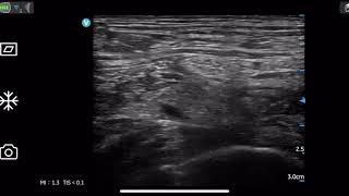 Femoral nerve block by Vscan Air [upl. by Dame]