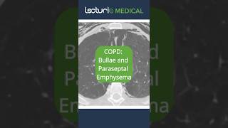 🔍 CT Scan Insights Bullae amp Paraseptal Emphysema EmphysemaInsights RadiologyRevealed usmle [upl. by Divine452]