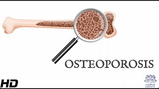 Osteoporosis Everything You Need To Know [upl. by Nor]