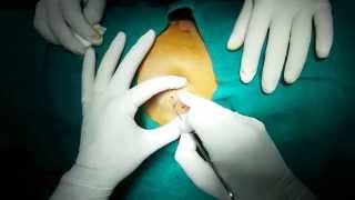 Excision of Sebaceous Cyst under Local Anesthesia [upl. by Wadell217]