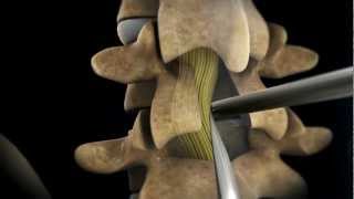 TLIF Transforaminial Lumbar Interbody Fusion  Larry Parker MD [upl. by Agnese661]