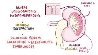 Hydronephrosis  Renal Pathology  Osmosis [upl. by Retnyw745]