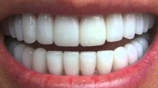 Get Perfectly Straight Teeth ―∎ affirmations  Cure Overbite Underbite amp Crossbite [upl. by Ansell]