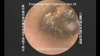 Cleaning of bilateral external auditory canal cerumen embolism in children 20241128 [upl. by Oirobil716]