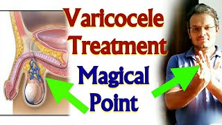 Acupressure Points For VARICOCELE  Acupressure For Varicocele  Varicose Veins In Scrotum In Hindi [upl. by Nrobyalc]