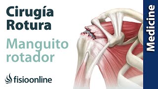 Lesión del manguito rotador  Qué es diagnóstico y tratamiento indicado en fisioterapia y cirugía [upl. by Mikkanen]