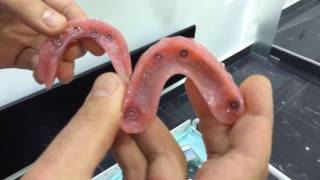 Proteza na drikere  Clipon dentures [upl. by Wynne]