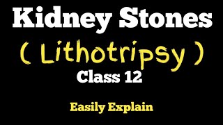 What Is Kidney Stone And What Causes It  Lithotripsy  Class 12 Biology [upl. by Nerissa]