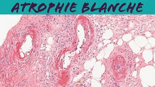 Atrophie blanche livedoid vasculopathy dermatology dermpath pathology [upl. by Mareld]