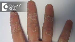 Causes of dry affected small skin patch on hand  Dr Aruna Prasad [upl. by Llenahs]