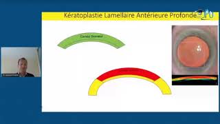 Kératocône en cas clinique congrès JPO 2021 [upl. by Moshell564]