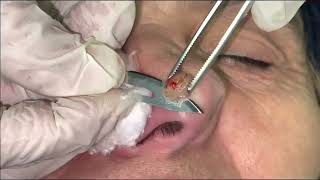 Keratoacanthoma biopsy taking [upl. by Anertal339]