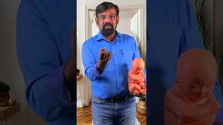 துணிச்சலான பெண்களின் கர்ப்ப காலக் கதை ovarian cyst in Baby Pregnancy story  Pink Chennai [upl. by Nimrahc]