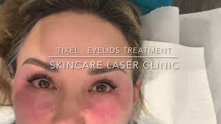 TIXEL EYELIDS TREATMENT  SKINCARE LASER CLINIC POINTCOOK MELBOURNE [upl. by Ansaev]