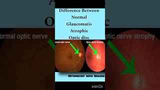 Difference between Normal Glaucomatous amp Atrophic Optic Disc opticdisc [upl. by Airdnaed]