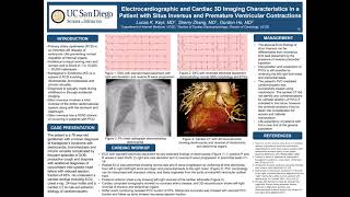 Electrocardiographic and Cardiac 3D Imaging Characteristics in Patient with Situs Inversus and PVCs [upl. by Idolem]