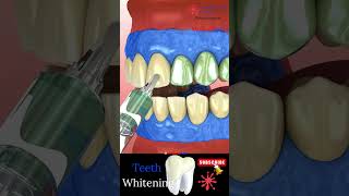 Instant Teeth Whitening 😬 Teeth care 🪥 Dental Clinic 🦷 Medical Animation [upl. by Mode]