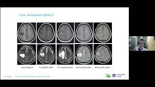 Minimally invasive techniques in brain oncology  D Ruess [upl. by Jo487]